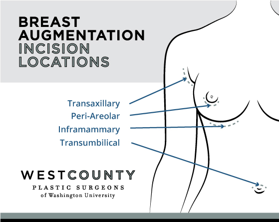 The West County Plastic Surgeons of Washington University team makes incisions in specific locations ideal for each individual breast augmentation patient in St. Louis.
