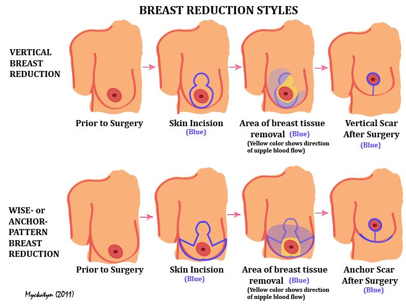 Illustration depicting breast reduction styles
