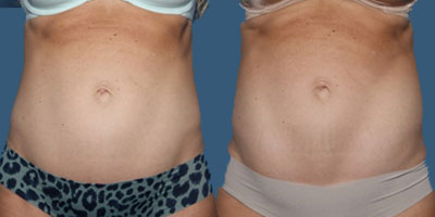 Before-and-after photos of a patient who choose CoolTone™ at St. Louis, West County Plastic Surgeons.