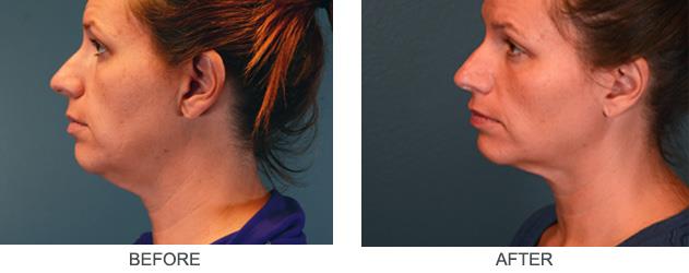ultherapy-before-after