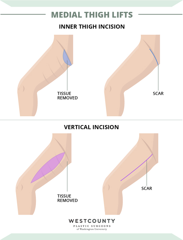 There are two types of incisions commonly used for thigh lifts at St. Louis' West County Plastic Surgeons: the inner thigh incision or the vertical incision.