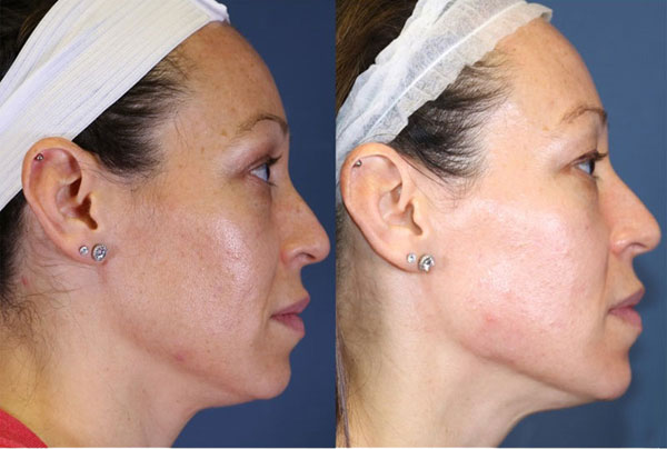 Before-and-after photos of a patient following a chemical peel at St. Louis' West County Plastic Surgeons.