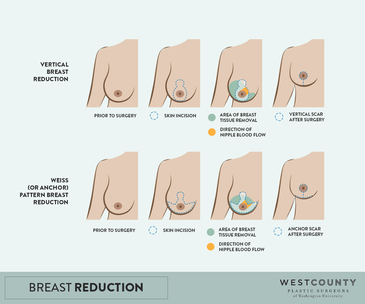 West County Plastic Surgeons chooses from the vertical technique of Weiss-pattern (anchor) technique for breast reduction at the St. Louis practice.