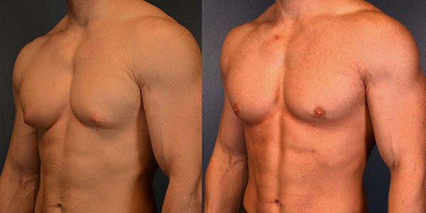 Gynecomastia (Male Breast Reduction) Sideview Before and After