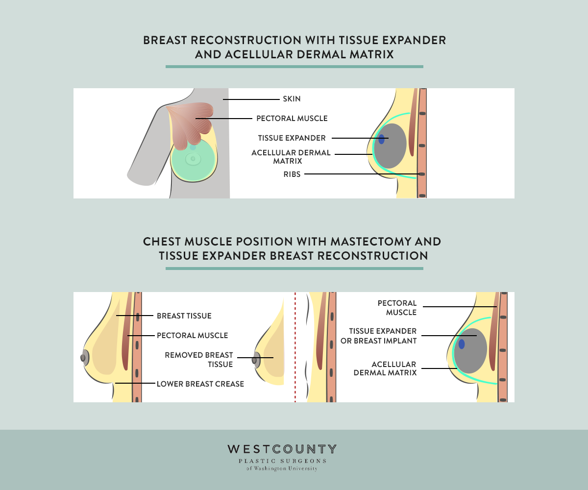 Get placement details for reconstruction with an implant or tissue expander at St. Louis’ West County Plastic Surgeons.