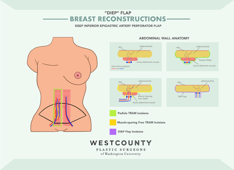 See how DIEP flap surgery at St. Louis' West County Plastic Surgeons works.
