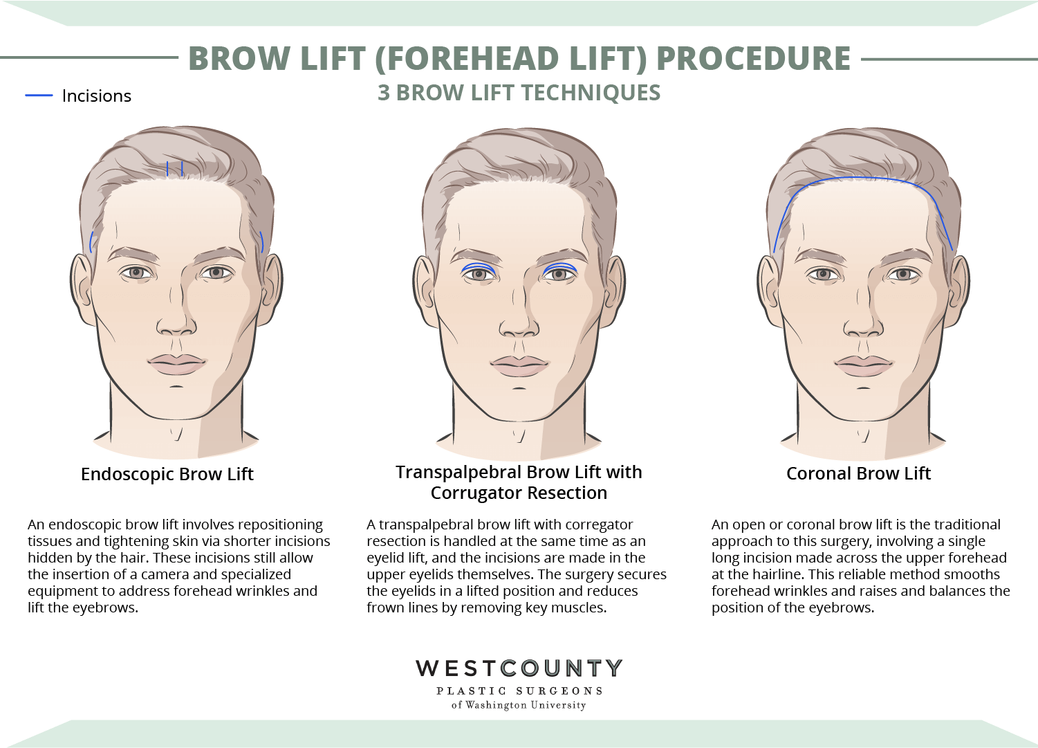 Learn the three variations of brow lift at St. Louis’ West County Plastic Surgeons.