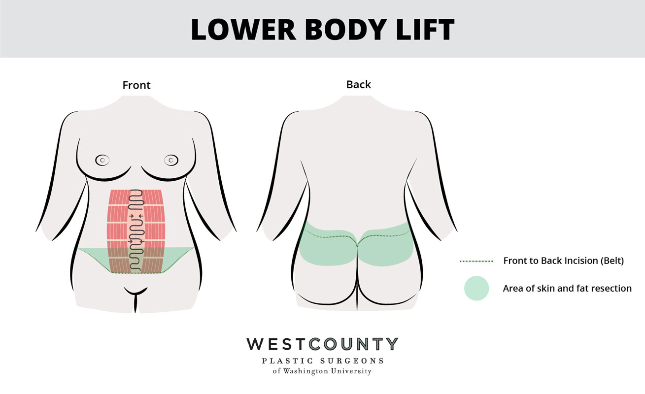 See what's involved in a lower body lift at St. Louis' West County Plastic Surgeons.