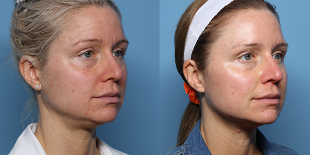 CoolPeel Sideview Before and After