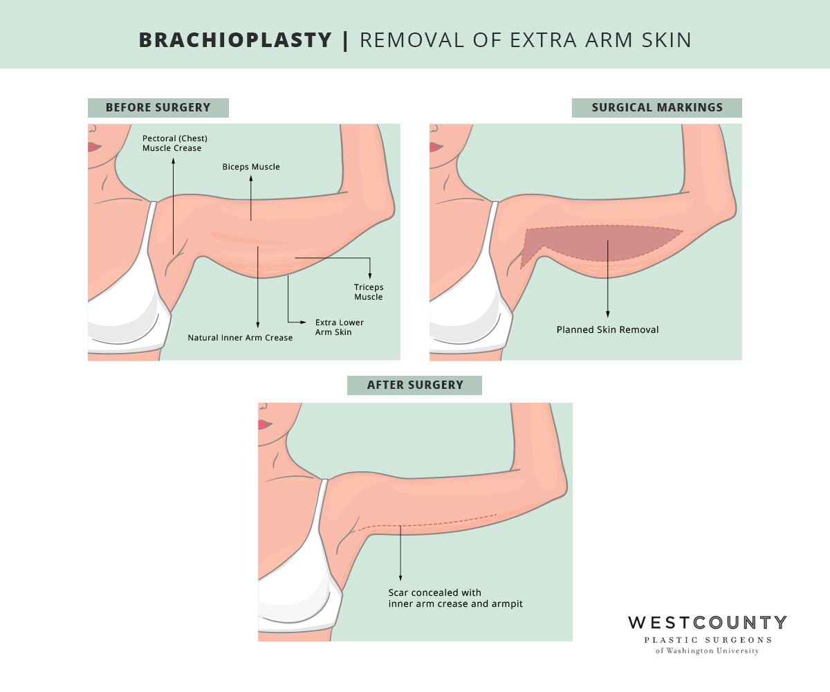 The West County Plastic Surgeons team customizes each arm lift in St. Louis to take muscles, creases, and other contours into account for a natural-looking result.