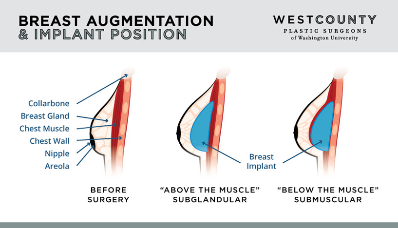 West County Plastic Surgeons of Washington University offers two types implant positions for breast augmentation in St. Louis.