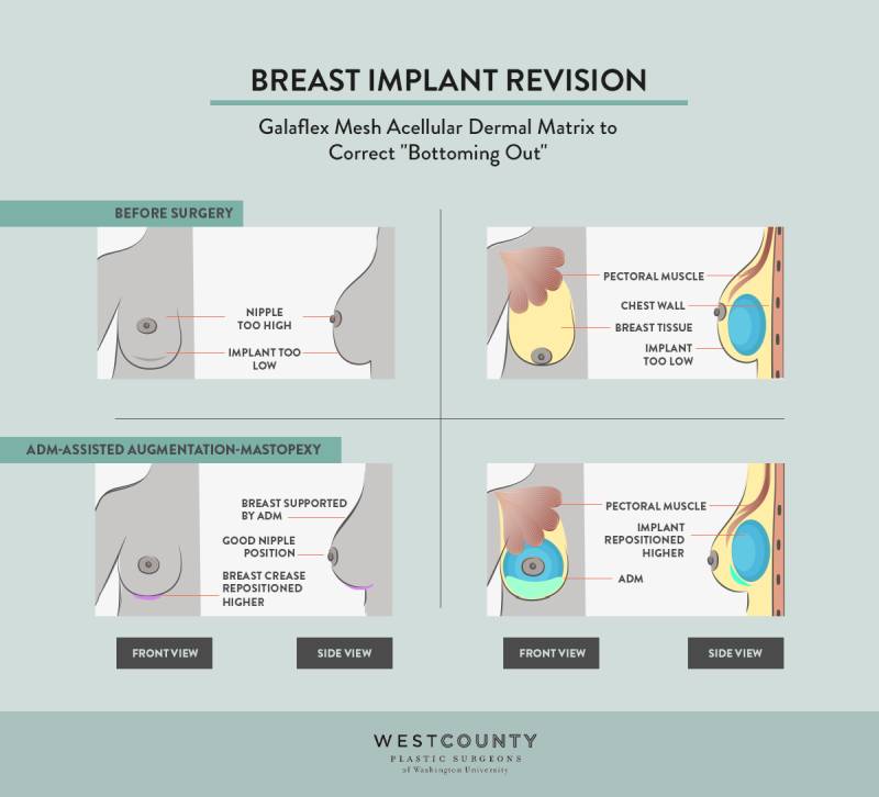 Acellular dermal matrix is used to accomplish breast implant revision surgery at St. Louis' West County Plastic Surgeons.
