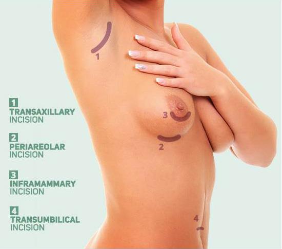 Breast_Incisions