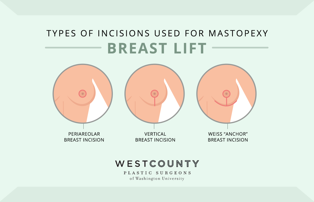 See the three incisions used for breast lift surgery (mastopexy) at West County Plastic Surgeons in St. Louis.