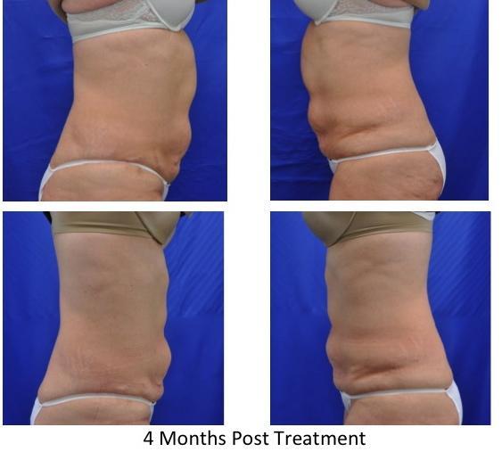 COOLSCULPTING-BEFORE-AFTER