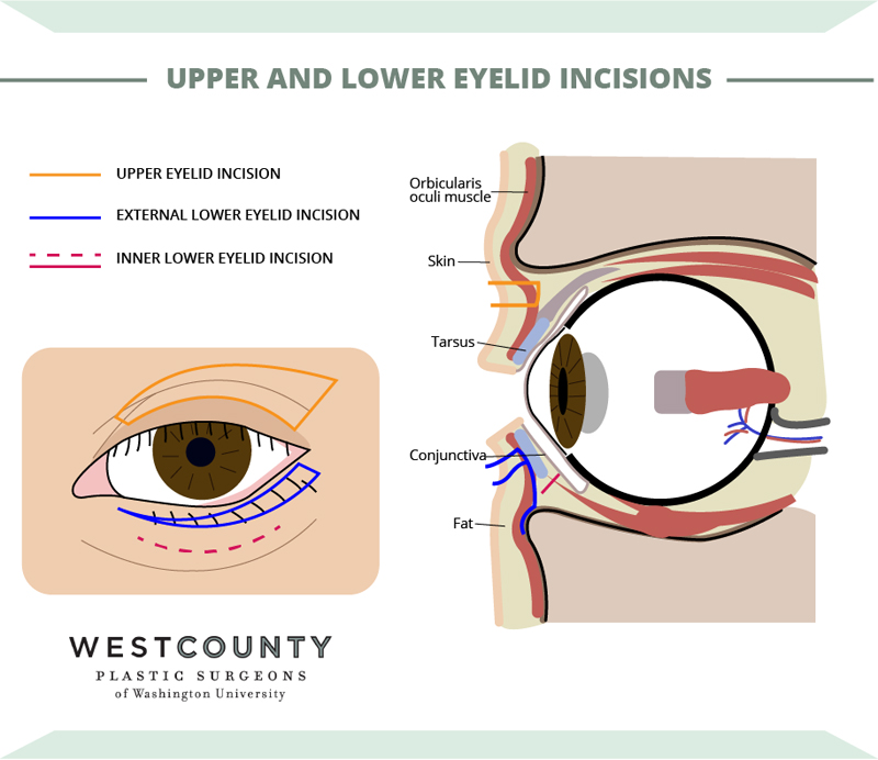 Discover the various incision options for blepharoplasty at St. Louis' West County Plastic Surgeons.