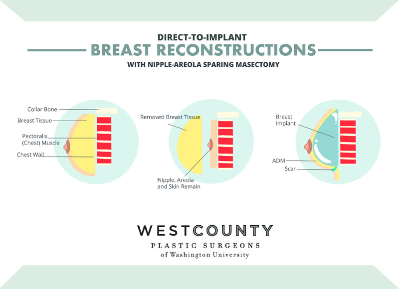 Direct-to-implant reconstruction at St. Louis' West County Plastic Surgeons pairs tissue-removing mastectomy with insertion of an implant.