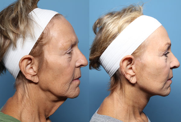 Facelift Sideview Before and After