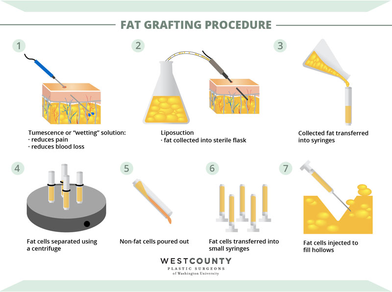 See how fat transfer at St. Louis' West County Plastic Surgeons works in seven steps.