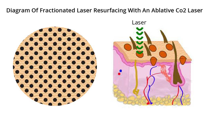 Fractionated-Laser-Diagram