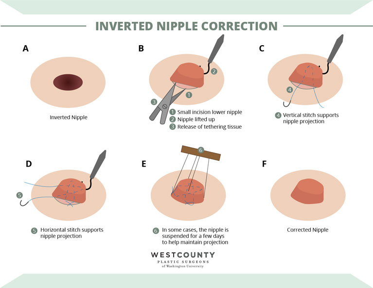 There are six steps to nipple correction at St. Louis' West County Plastic Surgeons.
