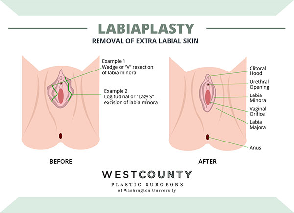 Learn labiaplasty surgery details at St. Louis' West County Plastic Surgeons.