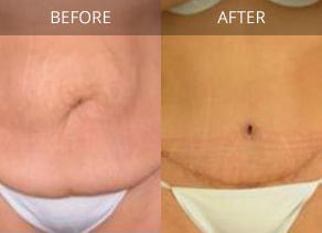 Tummy Tuck in St. Louis MO  Tummy Tuck Specialist St. Peters MO