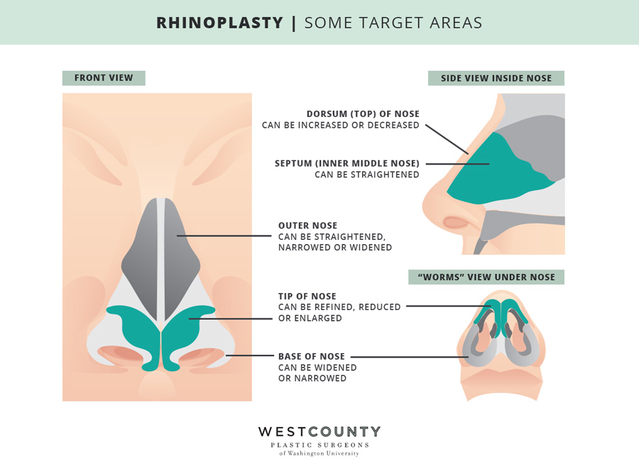 Take a closer look at the five areas of the nose that can be impacted by rhinoplasty at St. Louis' West County Plastic Surgeons.
