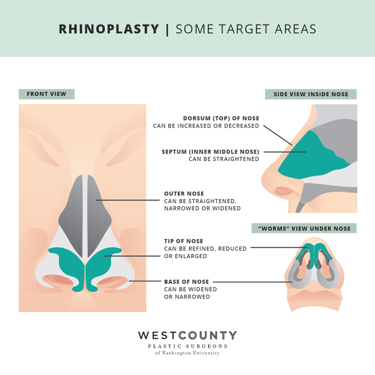 Take a closer look at the five areas of the nose that can be impacted by rhinoplasty at St. Louis' West County Plastic Surgeons.