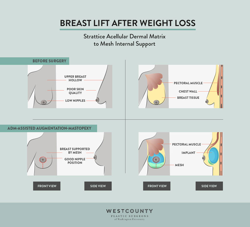 Our plastic surgeons use carefully positioned implants and an acellular dermal matrix to create perkier, natural-looking breasts via augmentation mastopexy in St. Louis.