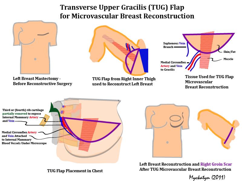 TUG Flap Breast Reconstruction