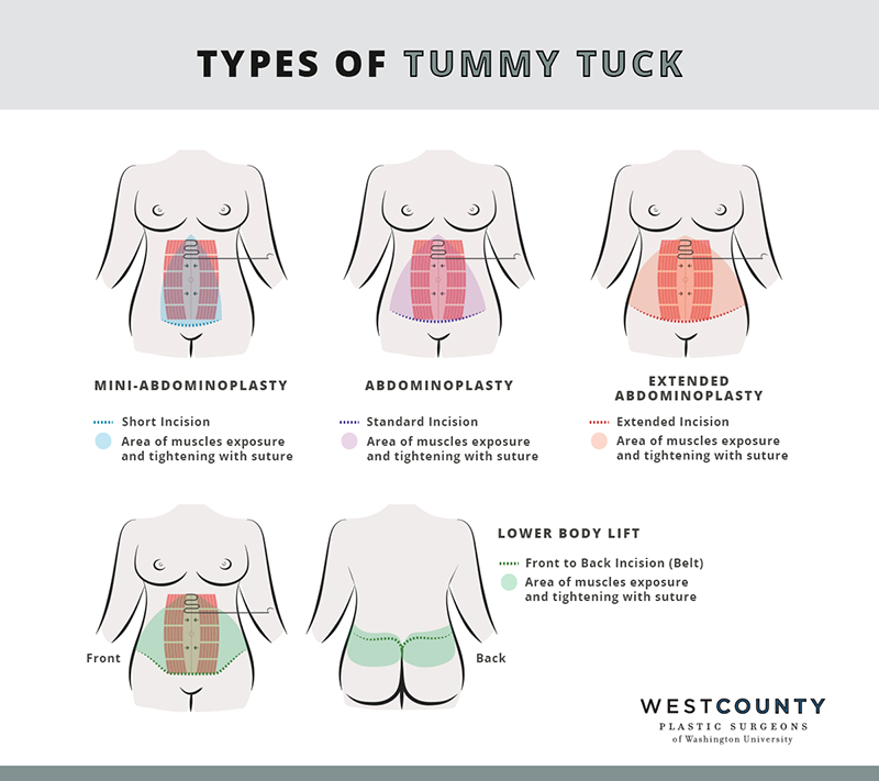 Choose from several methods of tummy tuck surgery at West County Plastic Surgeons in St. Louis.