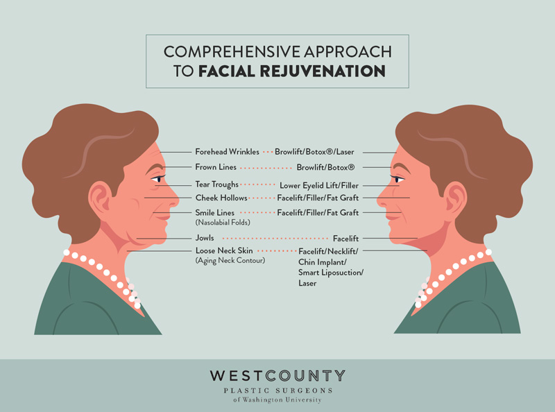 A comprehensive approach to facial rejuvenation typically includes a facelift at St. Louis' West County Plastic Surgeons.
