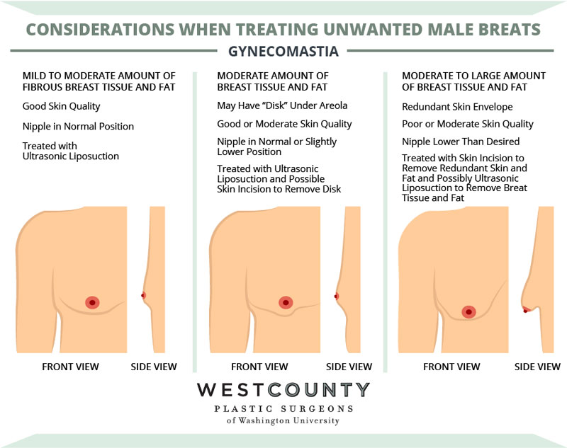 Gynecomastia treated at St. Louis' West County Plastic Surgeons of Washington University typically falls into one of three categories of severity, which determines the degree of correction needed.