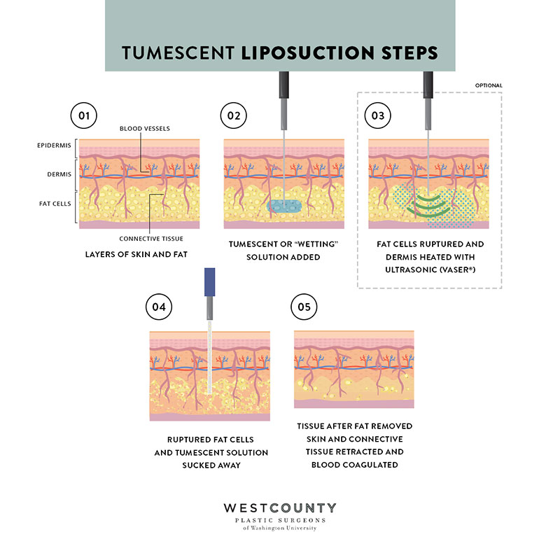 Learn the steps involved in tumescent liposuction at St. Louis' West County Plastic Surgeons.