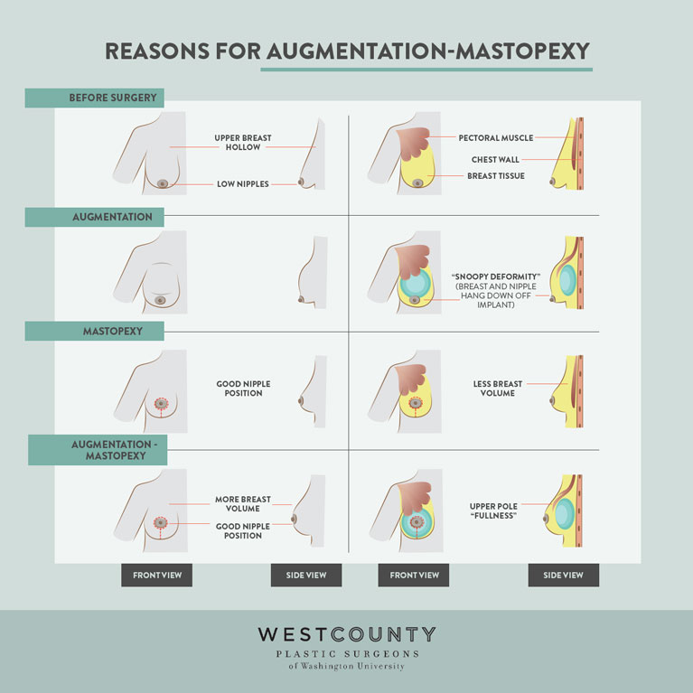 An augmentation-mastopexy adds volume while lifting sagging tissue to create a fuller, more elevated breast for patients at West County Plastic Surgeons in St. Louis.