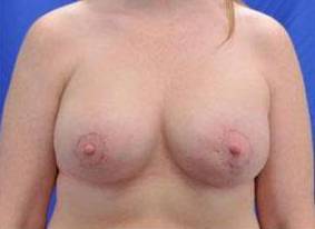CORRECTIVE BREAST SURGERY: CASE C5 After