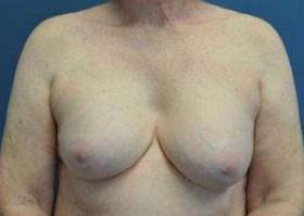 CORRECTIVE BREAST SURGERY: CASE C6 Before