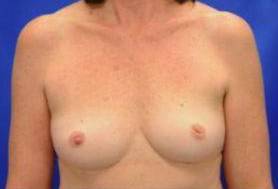 NIPPLE RECONSTRUCTION AND CORRECTION: CASE A2 Before