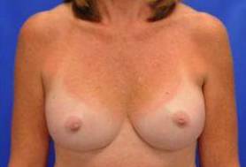 NIPPLE RECONSTRUCTION AND CORRECTION: CASE A2 After