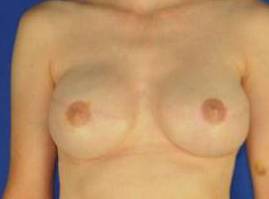 NIPPLE RECONSTRUCTION AND CORRECTION: CASE L7 After