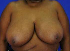 NIPPLE RECONSTRUCTION AND CORRECTION: CASE J8 Before