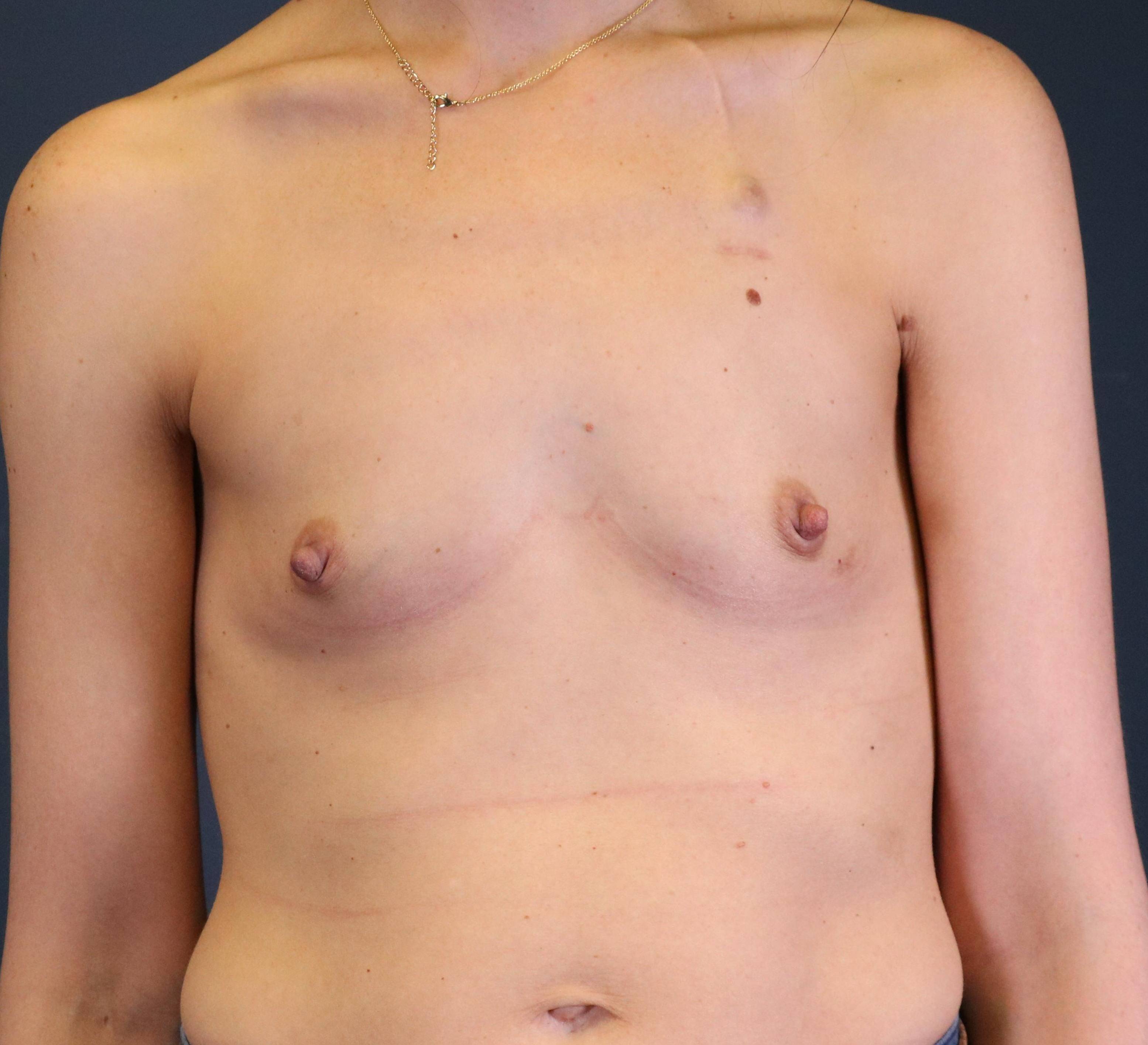 Breast Reconstruction with Implants: Case L29 Before