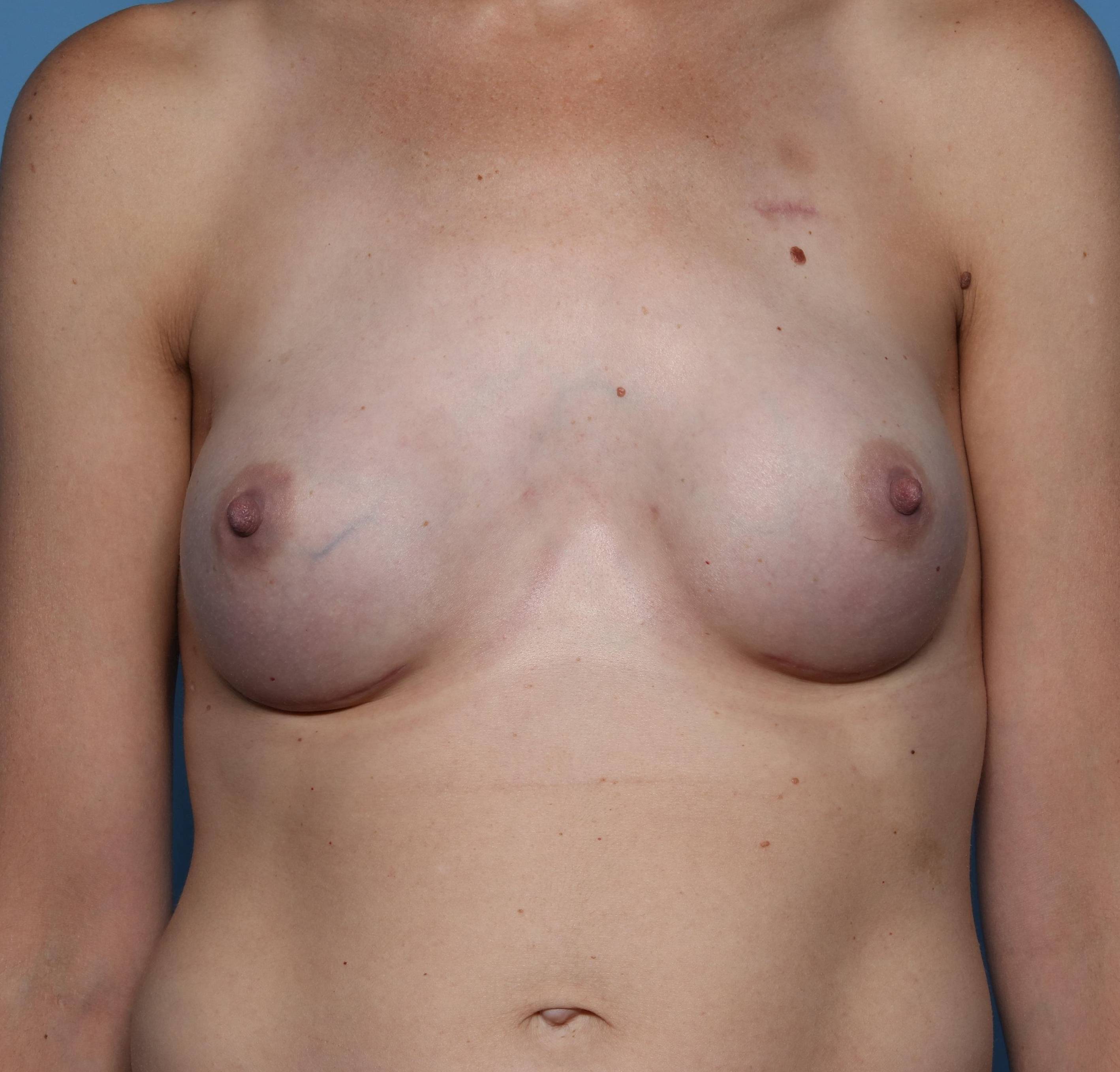 Breast Reconstruction with Implants: Case L29 After