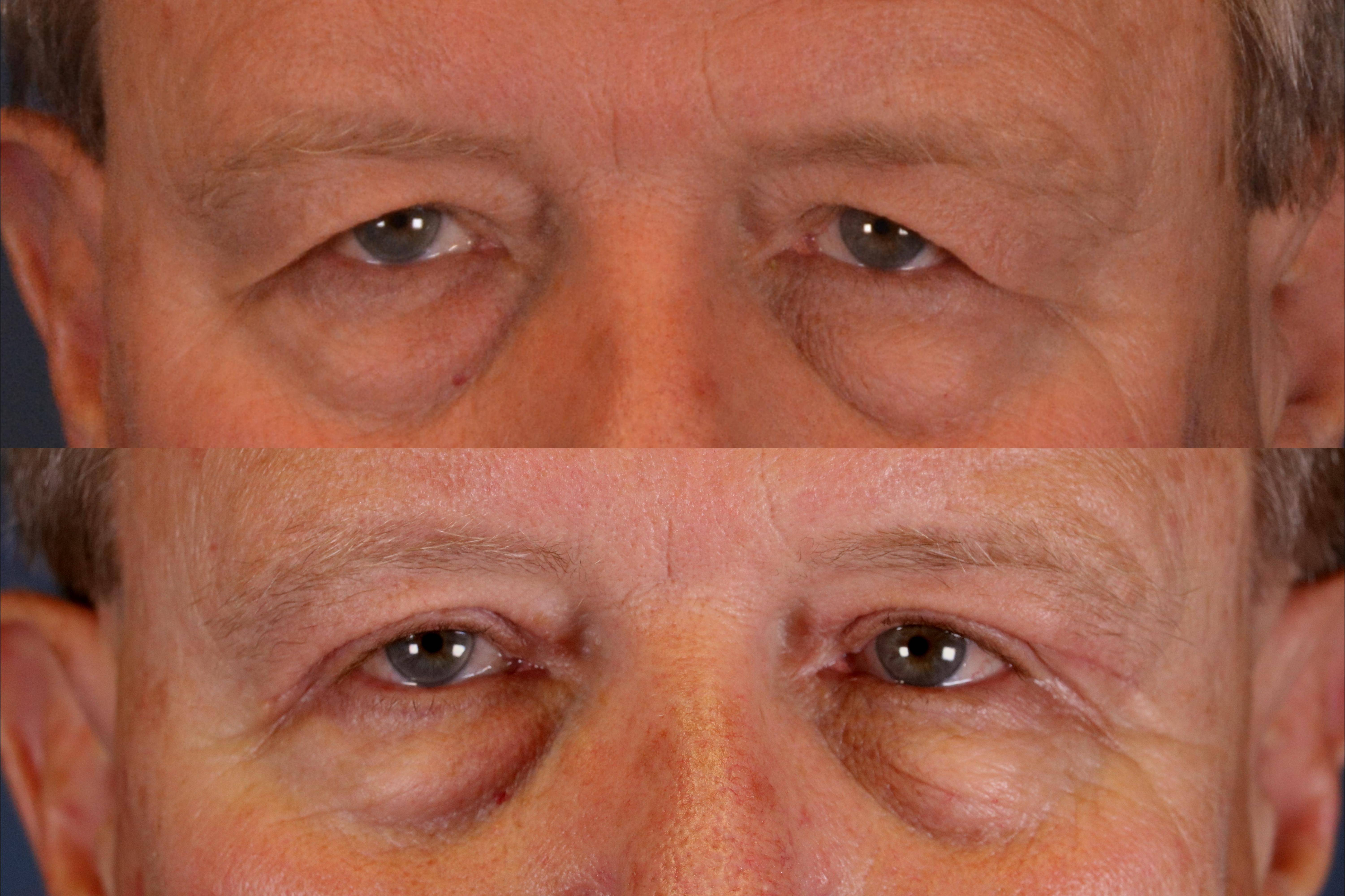 Eyelid Surgery and Forehead (Brow) Lifts: Case S4 