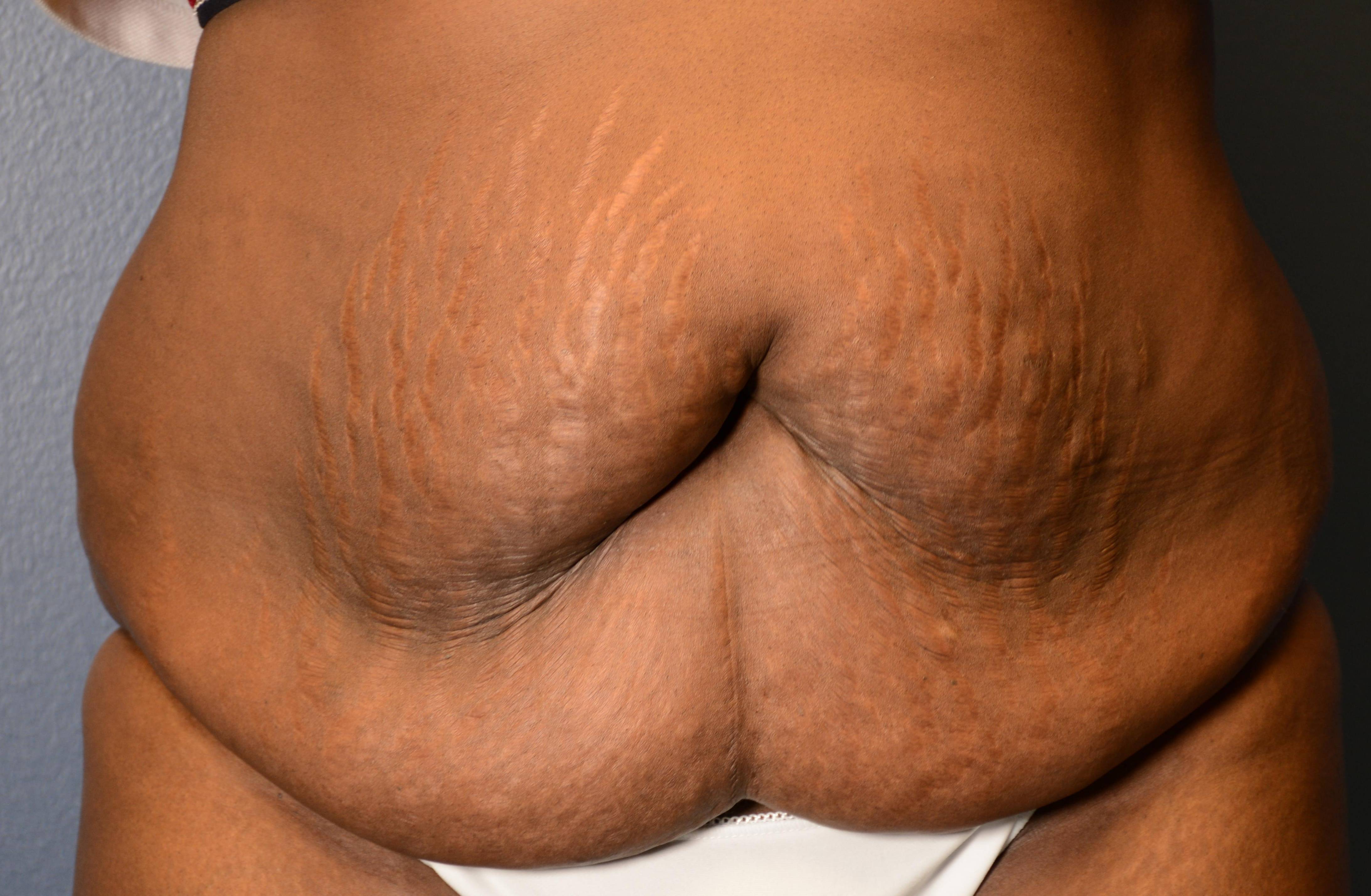 Tummy Tucks (Abdominoplasties): Case K2 Before