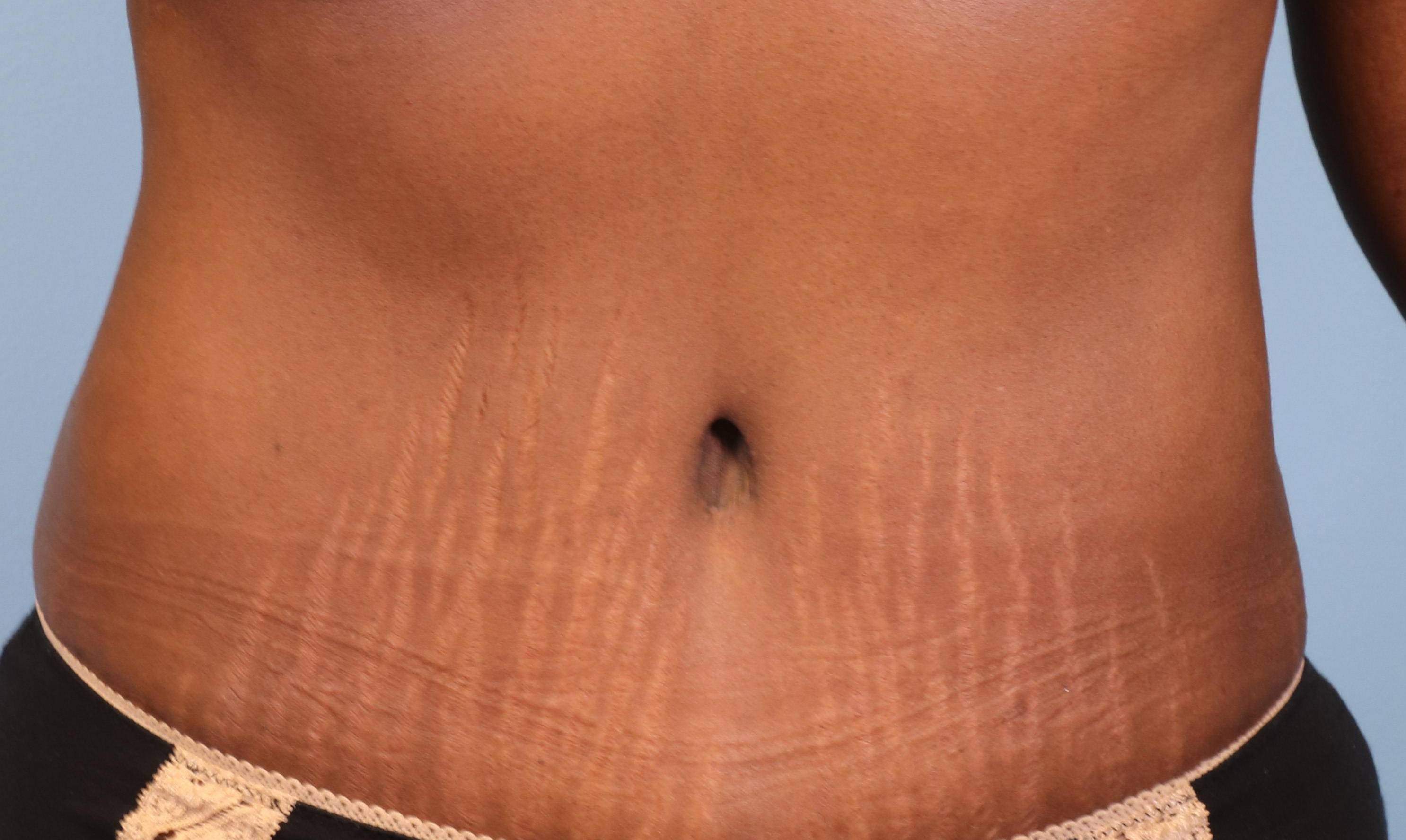 Tummy Tucks (Abdominoplasties): Case K2 After