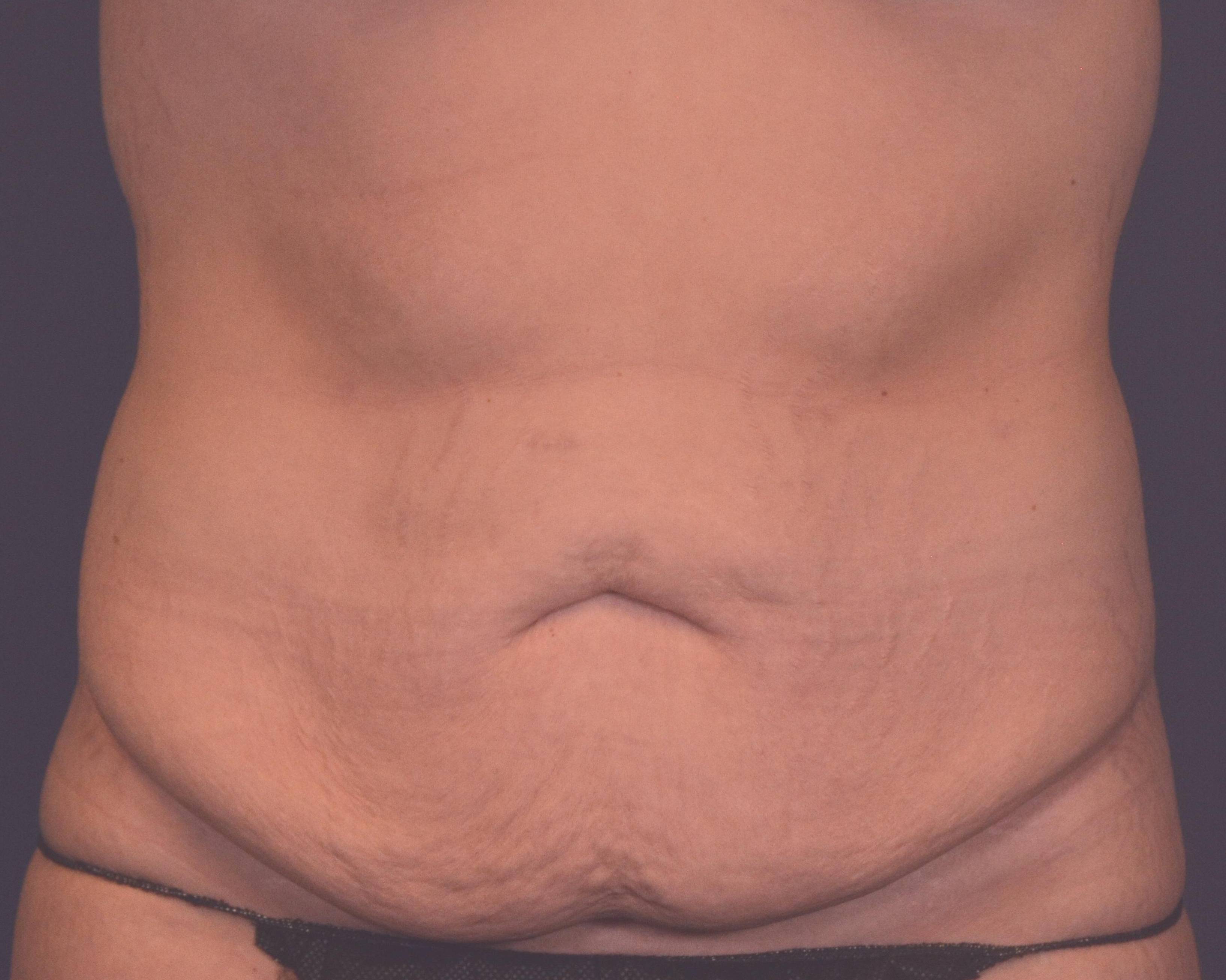Tummy Tucks (Abdominoplasties): Case I18 Before