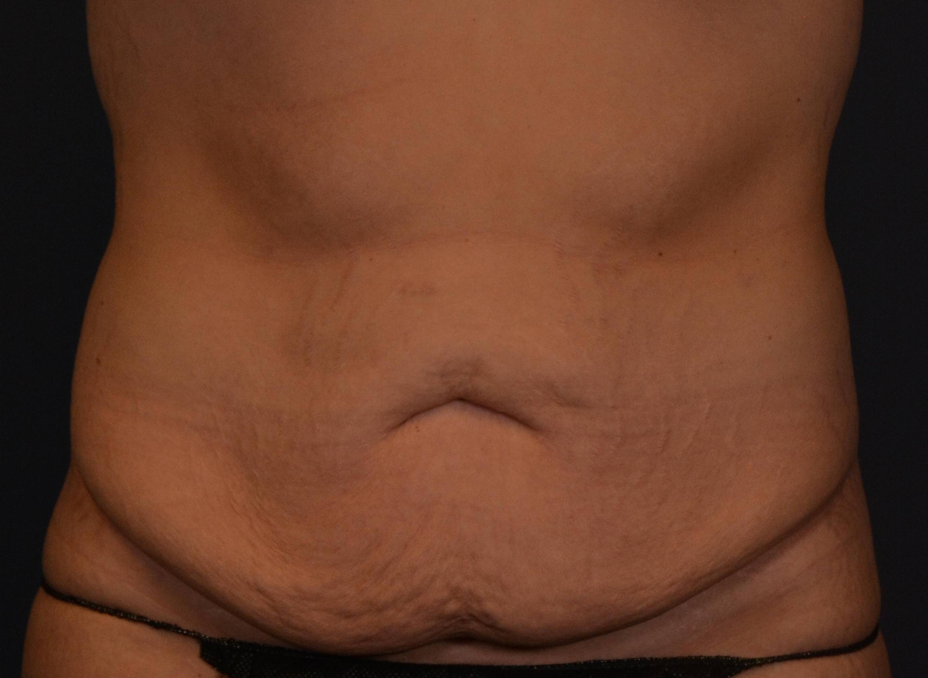 Tummy Tucks (Abdominoplasties): Case I18 After