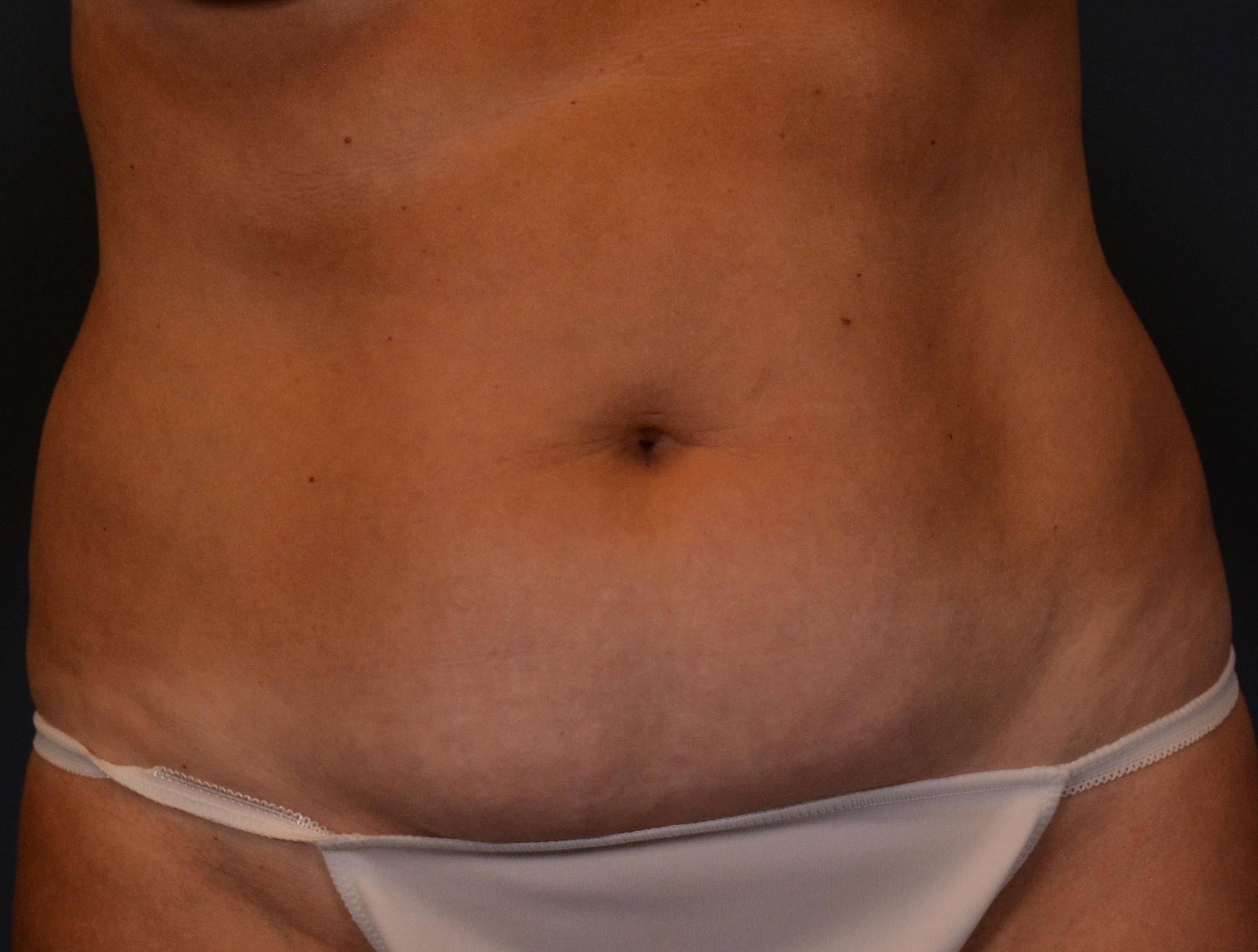 Tummy Tucks (Abdominoplasties): Case I21 Before